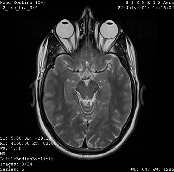 Mozek na MRI. Kredit: Ptrump16 / Wikimedia Commons.
