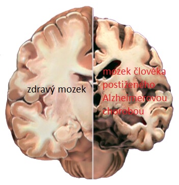 Alzheimerova choroba doslova ukusuje z lidského mozku a postupně připravuje  člověka o důležité kognitivní a později i motorické schopnosti. Mění povahu, radost, a zájem mění na úzkost a apatii. Dalo by se říct, že mu krade 