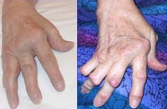 Arthritis rheumatica na kloubech ruky. (Kredit: National Institutes of Health) http://nihseniorhealth.gov/rheumatoidarthritis/whatisrheumatoidarthritis/01.html