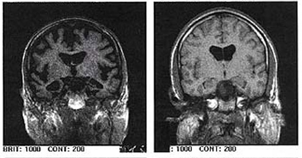 Snímek z magnetické rezonance dvou lidských mozků. Jistě netřeba uvést, který patří pacientu s Alzheimerovou nemocí. Zdroj: Wikipedia