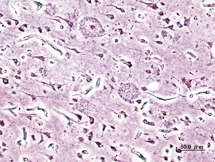 Histopatologický obraz plaků přítomných v mozkové kůře osob s Alzheimerovou nemocí s časným začátkem. Impregnace stříbrem.  Zdroj: Wikipedia