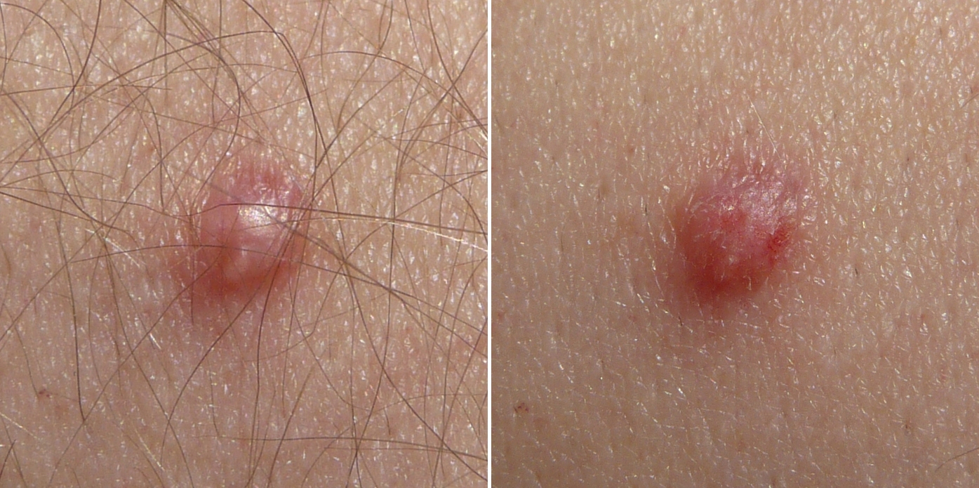 HPV papilómy na koži. (Kredit: George Chernilevsky. Wikipedia, Public Domain)