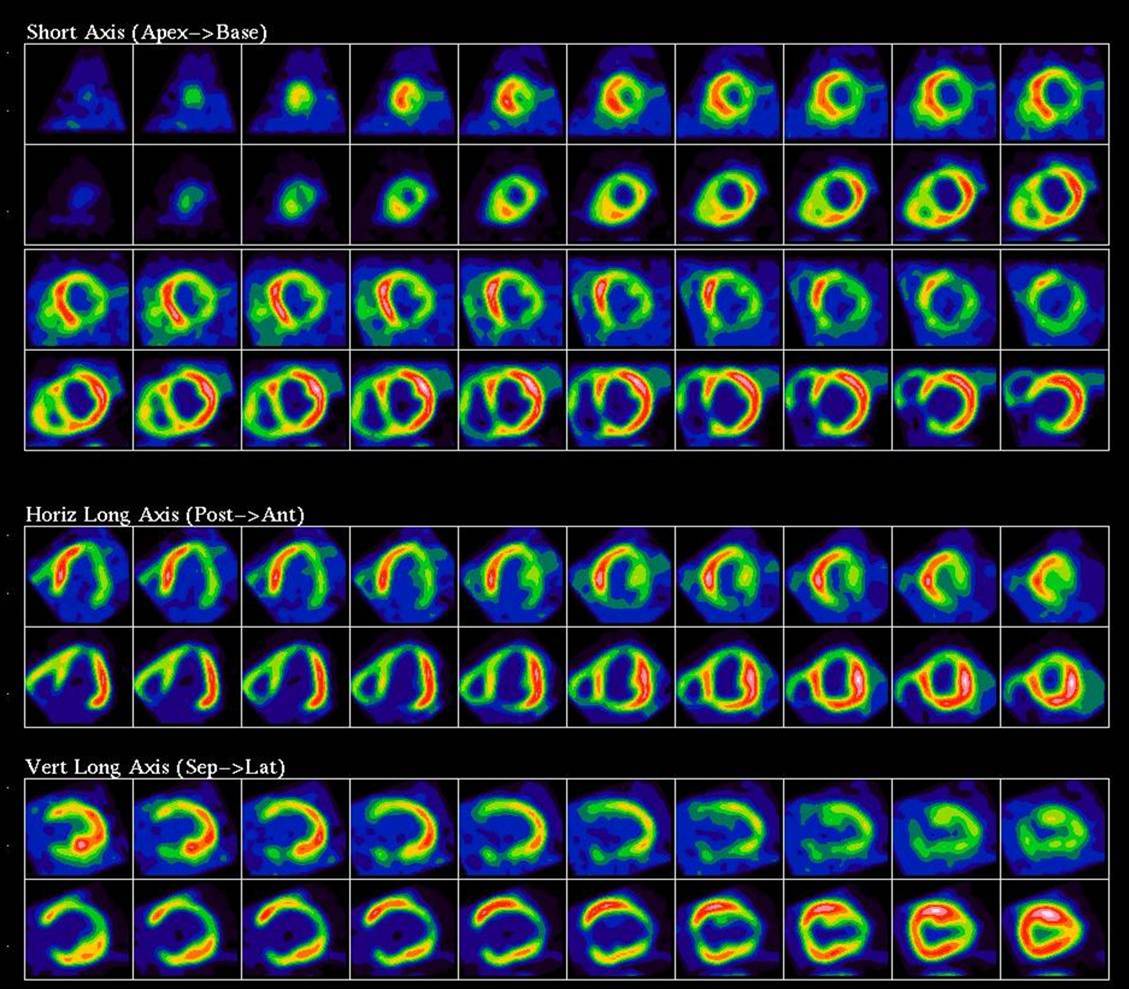 Posúdenie viability myokardu pomocou SPECT  (Single-proton emmision computed tomography): získané obrázky poskytujú dosť málo detailov. Kredit: Heart Institute, University od Ottawa.  https://www.ottawaheart.ca/test-procedure/pet-viability-imaging