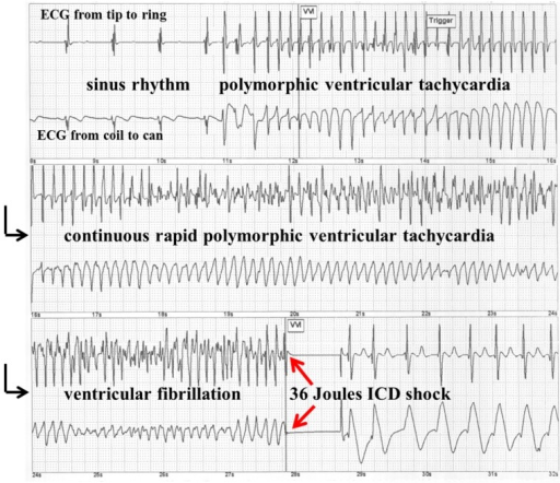 PodobnĂˇ situĂˇcia, vyrieĹˇenĂˇ kardioverterom/defibrilĂˇtorom. ZĂˇvaĹľno porucha srdcovĂ©hom rytmu, polymorfnĂˇ komorovĂˇ tachykardia preĹˇla v komorovĂş fibrilĂˇciu. V strede spodnĂ©ho riadku zĂˇznamu bola zastavenĂˇ defibrilaÄŤnĂ˝m vĂ˝bojom o ener