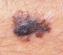 Jakmile znaménko, přestane být ohraničené a rozrůstá se do okolí, je to charakteristická známka melanomu.