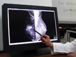 Syndrom Li-Fraumeni (LFS) je geneticky podmíněné onemocnění charakterizované obecně zvýšeným rizikem vzniku nádorového onemocnění. Popsali ho  Frederick Pei Li a Joseph F. Fraumeni jr. v roce 1969. Projevuje se mnohačetným nádorovým bujením v různých částech těla, typické jsou sarkomy měkkých tkání a adrenokortikální karcinomy. U 50 % žen se syndromem Li-Fraumeni se rozvíjí karcinom prsu. Kredit: IBM