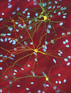 Na snímku pořízeném mikroskopem jsou vidět hojná jádra zdravých neuronů (modře). Žlutě zbarvený neuron uprostřed má v jádře inkluzi proteinu huntingtin (oranžově) - typický znak nemocných Huntingtonovou chorobou. Kredit: Wikipedia / Creative Commons Attribution 3.0 Unported licence.