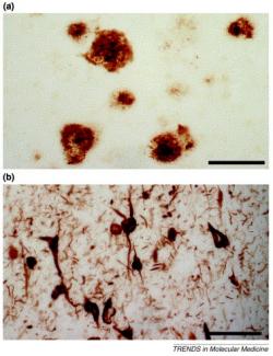 Amyloidní plaky (a) obarvené protilátkou proti amyloidu beta. Měřítko: 125 µm. Neurofibrilární klubka (b) barvená protilátkou proti helikálním vláknům hyperfosforylovaného proteinu tau. Měřítko: 62,5 µm. (Zdroj: LaFerla, F. M., & Oddo, S. (2005). Alzheimer's disease: Aβ, tau and synaptic dysfunction. Trends in molecular medicine, 11(4), 170-176).