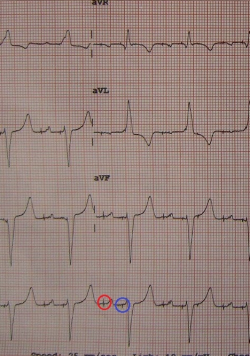EKG pacienta s fungujúcim kardiostimulátorom, jeho impulzy sú zakrúžkované: stimulujúci predsiene je červený, komory modrý. Kredit: James Heilman, MD, Wikipedia. CC BY-SA 3.0 EKG pacienta s fungujúcim kardiostimulátorom, jeho impulzy sú zakrúžkované: stimulujúci predsiene je červený, komory modrý. Kredit: James Heilman, MD, Wikipedia. CC BY-SA 3.0