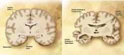 Prierez zdravým mozgom (vľavo) a mozgom pacienta s Alzheimerovou chorobou (vpravo)