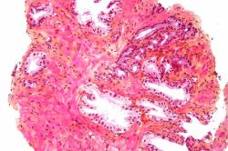 Adenokarcinóm prostaty pri mikroskopickom vyšetrení – vidieť iný vzhľad tkaniva na obrázku vpravo hore. Kredit: Nephron, Wikipedia. CC BY-SA 3.0