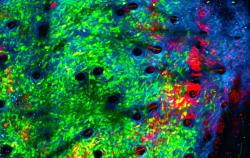 Rakovinné buňky (zeleně) napadené neutrofilními granulocyty (červeně) v kolagenové struktuře (modře) nádoru  Kredit: Jacqueline Baileyá / Dr Chtanova's Innate Tumour Immunology Lab at Garvan