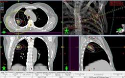 Liečebný plán stereotaktickej rádioterapie pre malý nádor pľúc - žiarenie sa koncentruje do nádoru s minimálnym poškodením okolia. Figure 1 (Steven W. Davis et al.: TCR, 2014) k otevření v článku ZDE.