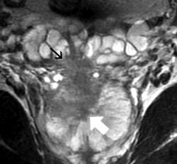 Vyšetrenie pomocou nukleárnej magnetickej rezonancie zobrazuje vysoko rizikový karcinóm prostaty (biela šípka), šíriaci sa do semenného vačku (čierna šípka). Kredit:  Sadhna Verma and Arumugam Rajesh, ARJ 2011.  https://ajronline.org/doi/full/10.2214/AJR.09.7196