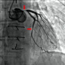 Nález zúžených úsekov koronárnych tepien na snímke z koronárnej angiografie. (Kredit: Wikimedia)