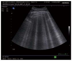 Ultrazvukový obraz pri ťažkom srdcovom zlyhávaní - lúčovité B -línie pri ultrazvukovom vyšetrení hrudníka   Kredit:  Luciano Cardinale et al., World J Radiol. 2014 June 28; 6(6): 230-237.