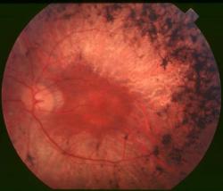 Oční pozadí (fundus oculi) pacienta se střední těžkou formou pigmentové retinitidy (retinitis pigmentosa) Kredit: Christian Hamel, Wikimedia Commons, CC BY 2.0