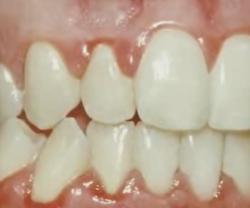 Parodontální onemocnění se projevuje zánětem dásní kolem zubů. Ty na snímku se nezdají být zanedbané, přesto bez odborného stomatologického ošetření jsou odsouzeny na postupné vypadávaní. Zanícené oteklé dásně chrání plak osídlený  bakteriemi před zubním kartáčkem. Kredit: MilesMadisonDDS, YouTube screenshot, video https://youtu.be/kXI4AFEeHA8