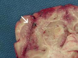 Brutálně poškozená mozková kůra po úmrtí na neglerie. Kredit: CDC.