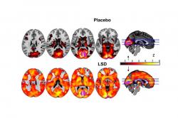 Nahoře působení placeba, dole LSD: Kredit: Carhart-Harris et al. 2016