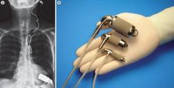 Implantované podporné čerpadlá Jarvik sú dostupné aj pre deti. Zdroj: (Stephen Westaby, et al., Cardiogenic shock in ACS. Part 2: role of mechanical circulatory support, Nature Reviews Cardiology).