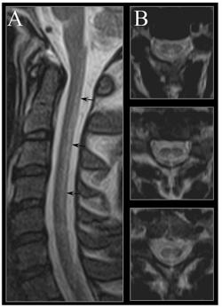 Poškodenie miechy pri dlhodobom nedostatku vitamínu B12, dnes už extrémne zriedkavé, zobrazenie nukleárnou magnetickou rezonanciou. Kredit: Chiara Briani, Nutrients, 2013, NIH.