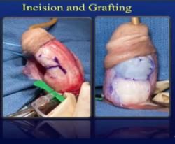 Ukázka jedné z technik. Vlevo incize. Vpravo jsou patrny vložené štěpy tukové tkáně kvůli  zvětšení objemu penisu. Kredit: Trost, Mayo Clinic.