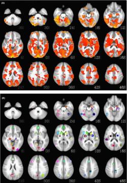 Nahoře skenu mozku s bipolární poruchou, dole zdravý mozek, Kredit: David Fleck/University of Cincinnati.