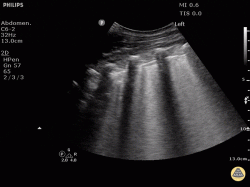 Ultrasonografický nález na pľúcach pri akútnom srdcovom zlyhaní (pruhy, tzv. B-línie však nie sú vždy také jednoznačné, ako na tomto obrázku). Kredit: Dr. Justin Bowra et al. (Dr. D Browne and Dr. J Knights), Basics of Echocardiography and Pulmonary Ultrasound.