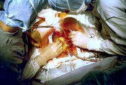 Operácia aortokoronárneho premostenia (bypassu). Kredit: Wikimedia Commons.