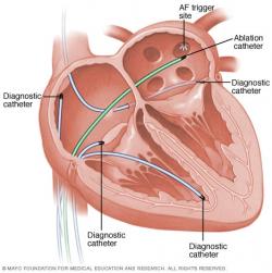 Pri rádiofrekvenčnej ablácii je srdce plné katétrov – väčšina je diagnostických, umožňujúca snímanie a podrobnú analýzu elektrokardiogramu, jeden slúži na abláciu (na obrázku ten zelený). (Kredit: Mayo Faundation for Medical Education and Research).