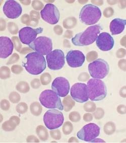 Kostná dreň pacienta s akútnou lymfatickou leukémiou - obsahuje množstvo lymfoblastov, ktoré sa farbia fialovo. Kredit:   VashiDonsk, English Wikipedia CC BY-SA 3.0