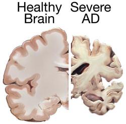 Zdravý mozek ve srovnání s mozkem postiženým Alzheimerovou chorobou v pokročilém stádiu Kredit: National Institutes of Health, Wikipedia, volné dílo.