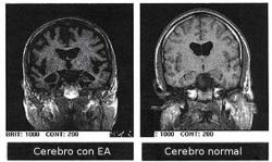 Snímkování MRI (magnetická rezonance) lze u nemocných AD odhalit celkovou atrofii mozku. Ta se projeví až v pokročilém stadiu nemoci. Vpravo je pro srovnání mozek zdravý. (Kredit: Wikimedia,  CC BY-SA 3.0)