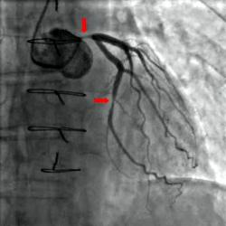 Koronárny angiogram s vyznačenými zúženiami koronárnych tepien. Kredit:  Maria A Pantale, Wikipedia. CC BY 2.0