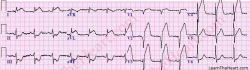 Typický obraz srdcového infarktu na EKG vyrieši problém raz a navždy. Ak je však elektrokardiogram negatívny, stanovenie alebo vylúčenie ochorenia koronárnych tepien srdca môže byť aj veľmi komplikované