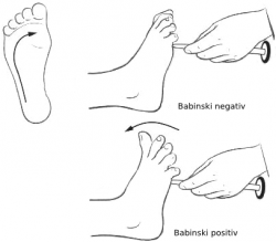 Babinského reflex, který se k diagnóze nemocných ALS občas používá, se nazývá podle objevitele, francouzského neurologa Josepha Babinskiho. Pokud lehce pohybujeme tupým předmětem po chodidle od paty k malíčku, normální reakcí zdravého dospělého člověka je pokrčení palce směrem dolů (flexe). Opačná reakce (extenze), signalizuje onemocnění. Kredit: Roxbury-de, načetl Malki na projektu Wikipedie, CC BY-SA 3.0)  https://commons.wikimedia.org/w/index.php?curid=4663315