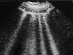 Lúčovité biele pásy na ultrazvukovom zobrazení hrudníka - B-línie. (V zásade, zdravé pľúcne tkanivo nie je ultrazvukom zobraziteľné - netvorí ultrazvukové odrazy) Kredit:  Guidelines for Lung Ultrasound