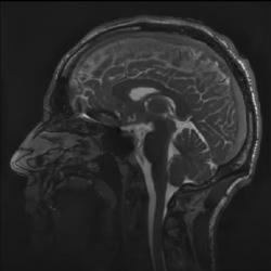 MRI snímek mozku v sagitální rovině Kredit: Mātai Medical Research Institute, Gisborne-Tairāwhiti, New Zealand.