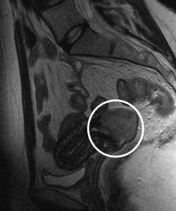 Karcinóm krčku maternice, zobrazený pri MRI vyšetrení panvy. (Kredit: Wikipedia, CC BY-SA 3.0)