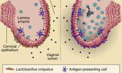 I když v obou případech je v pochvě virových partikulí (černě) stejně, u ženy vlevo vhodné bakterie (zde laktobacily) vytvořily na sliznici jakýsi obranný štít. U té vpravo kryjí povrch sliznice nevhodné bakterie, které vyprovokovaly imunitní systém a ten do lumenu vyslal početnější armádu  bílých krvinek. Ta ale paradoxně nevylepší své nositelce obranu vůči virové nfekci HIV, ba přímo naopak! Jeden z typů bílých krvinek (T lymfocyty) je totiž primárním cílem HIV virů. V tělech těchto buněčných obránců se virus množí. Proto v případě pohlavního styku s nakaženým mužem, nevhodný vaginální mikrobiom ženě riziko onemocnění HIV několikanásobně zvyšuje. Kredit: Gosmann et al./ Immunity 2017