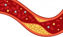 Prosím neplést  pojmy tuk s lipoproteinem. Lipoprotein přezdívaný „zlý cholesterol“ jednak není tukem a navíc je záležitostí „vnitřku“ cév, nikoli „vnějšku“, kterého se nový objev týká. Na obrázku je „usazenina cholesterolu“ zužující průtok krve cévou. Kredit: NIH.