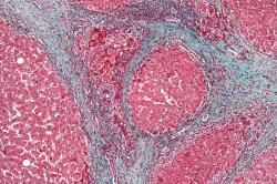Mikroskopický obraz ukazuje kvapôčky tuku v tkanive pečene. Stukovatenie sa dá rozpoznať aj vizuálne, prípadne zobrazovacími vyšetreniami (napr. Ultrasonograficky). Kredit: By Nephron - Own work, CC BY-SA 3.0.