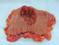 Kolorektální karcinom na kousku vyoperovaného tlustého střeva. Kredit: Emmanuelm, Wikipedia, CC 3.0