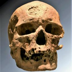 Slavná lebka Cro-Magnon 1, s jasně patrnou stopou po nádoru na čele. Kredit: 120 / Wikimedia Commons.
