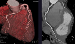 Umělá inteligence analyzuje snímky CT angiografie a na jejich základě předpovídá riziko infarktu. Kredit: Healio.