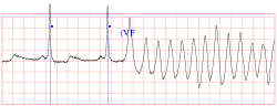 A je zle! EKG záznam z kardiomonitora zachytáva dva posledné normálne sťahy srdca (označené modrými bodkami) a potom komorovú fibriláciu (VF). Pacient upadol do klinickej smrti. (Kredit: Creighton University Ventricular Tachyarrhythmia Database)