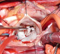 Otvor do hrudníka pri klasickej operácii je oveľa väčší, viac bolí a dlho sa hojí.