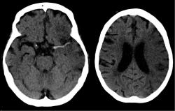 Nejčastějšími příčinami lidské demence jsou mozková mrtvice a Alzheimerova choroba. Na skenu mozku pacienta s čerstvým infarktem je vidět příčina - poškození střední mozkové tepny. Obrázek vpravo je stav po 7 hodinách. Poškození mozku je na něm již dobře patrné. Transplantace gliových buněk se jeví být cestou, která by takto postiženým mohla výkonnost mozku do jisté míry navracet.  Autor fotografie: Hellerhoff, Wikipedia, CC BY-SA 3.0.