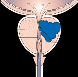 V Evropě je karcinom prostaty druhým nejčastějším zhoubným nádorem mužů a třetí nejčastější příčinou jejich úmrtí na maligní nádor. Bohužel ho často zaregistrujeme až když nás tlakem na močovod připraví o mocný střik. Většinou  začíná tkáň bujet na periferii a než začne stlačovat močovod, trvá to dlouho a pak už je nemoc v pokročilém stadiu. (Kredit: Nuada Prostate Care)